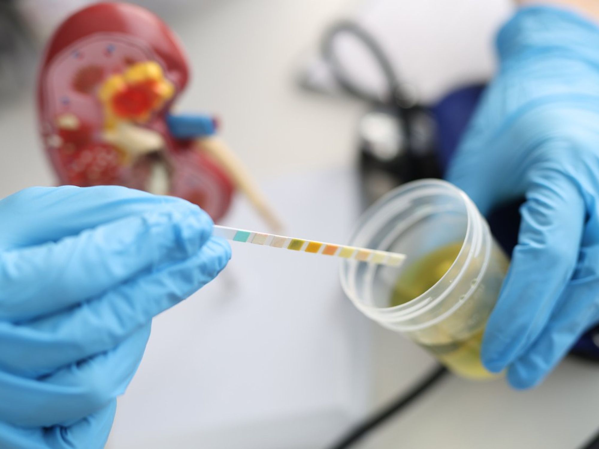 10 razones por las cuales podrías tener sangre en la orina