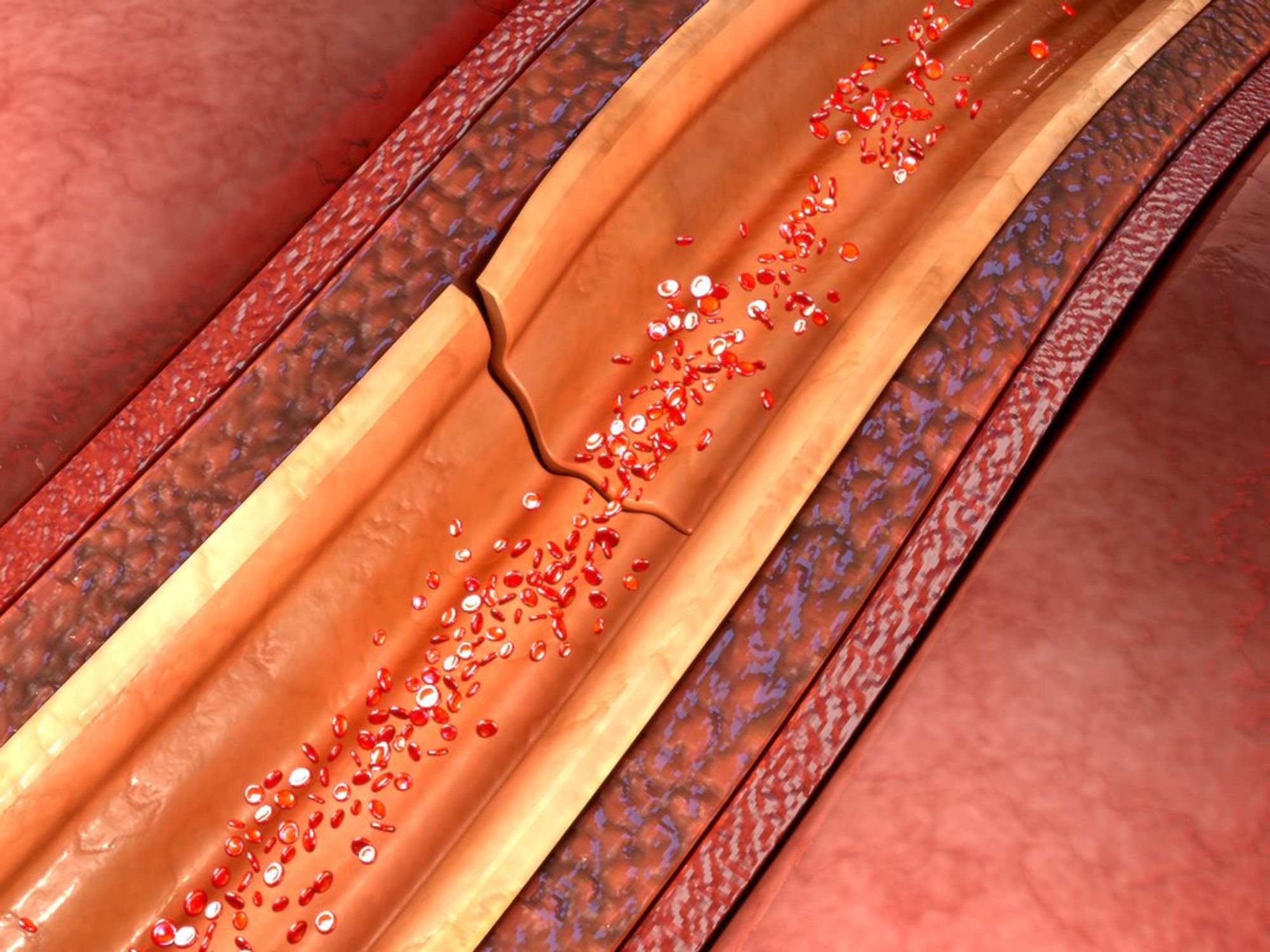 Spontaneous Coronary Artery Dissection 101