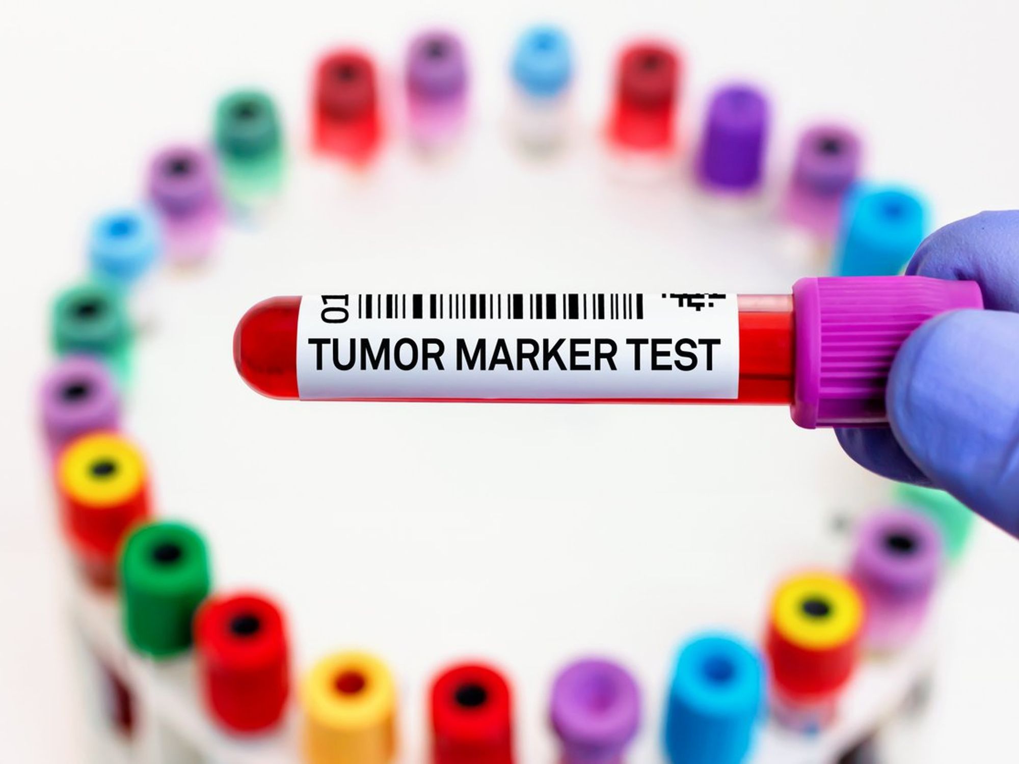 Tumor marker test blood sample in laboratory.